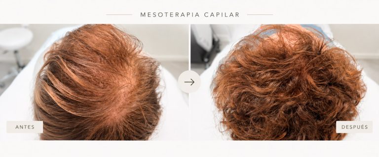 Mesoterapia capilar Dermadenia