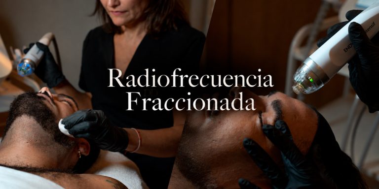 Radiofrecuencia fraccionada Dermadenia